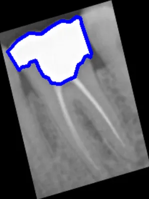 AugmenTory Dental Affine Rotation & Crop